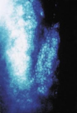 Fig. 22.8, High-magnification slit lamp photomicrograph of deep folds in the endothelial mosaic, indicating buckling of the posterior stroma caused by excessive oedema.