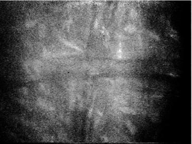 Fig. 22.9, Confocal micrograph of vertical and horizontal folds in an eye that had worn a hydrogel contact lens overnight (the image was captured within 30 minutes of awakening).