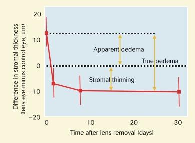 Fig. 23.2, Recovery of corneal oedema after cessation of lens wear for 1 month after 5 years of soft lens extended wear, illustrating the relationship between true oedema, apparent oedema and stromal thinning.