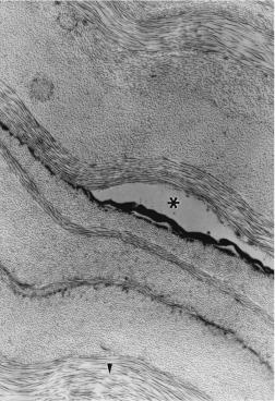 Fig. 23.3, After polymethyl methacrylate (PMMA) lens wear, stromal oedema is most conspicuous around keratocytes and between lamellae, where pooling of extracellular fluid (asterisk) may be present. Intra-lamellar swelling (triangle) is also evident in places. Primate. Electron micrograph. Magnification × 8,500.