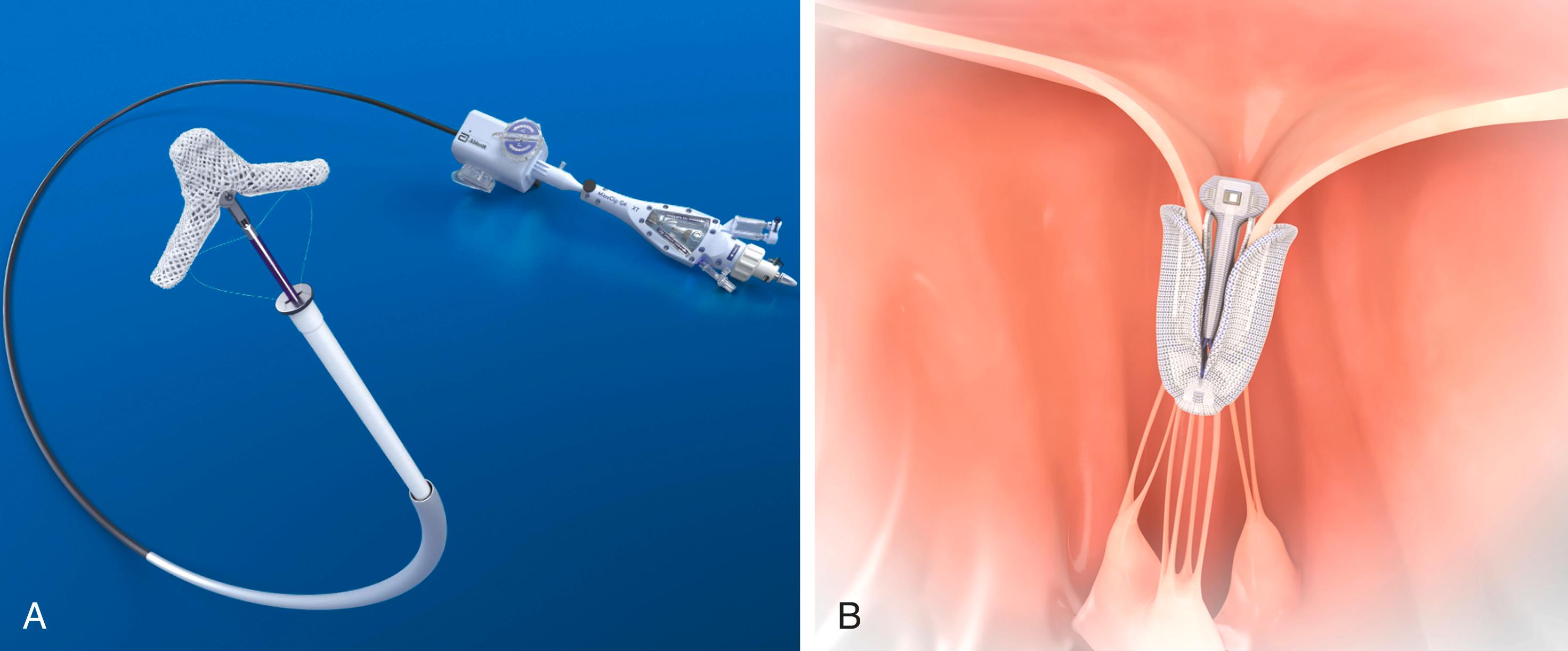 Figure 23.4, Transcatheter edge-to-edge repair devices. (A) The MitraClip G4 with clip delivery system, and (B) the PASCAL implant grasping the mitral valve leaflets are shown.