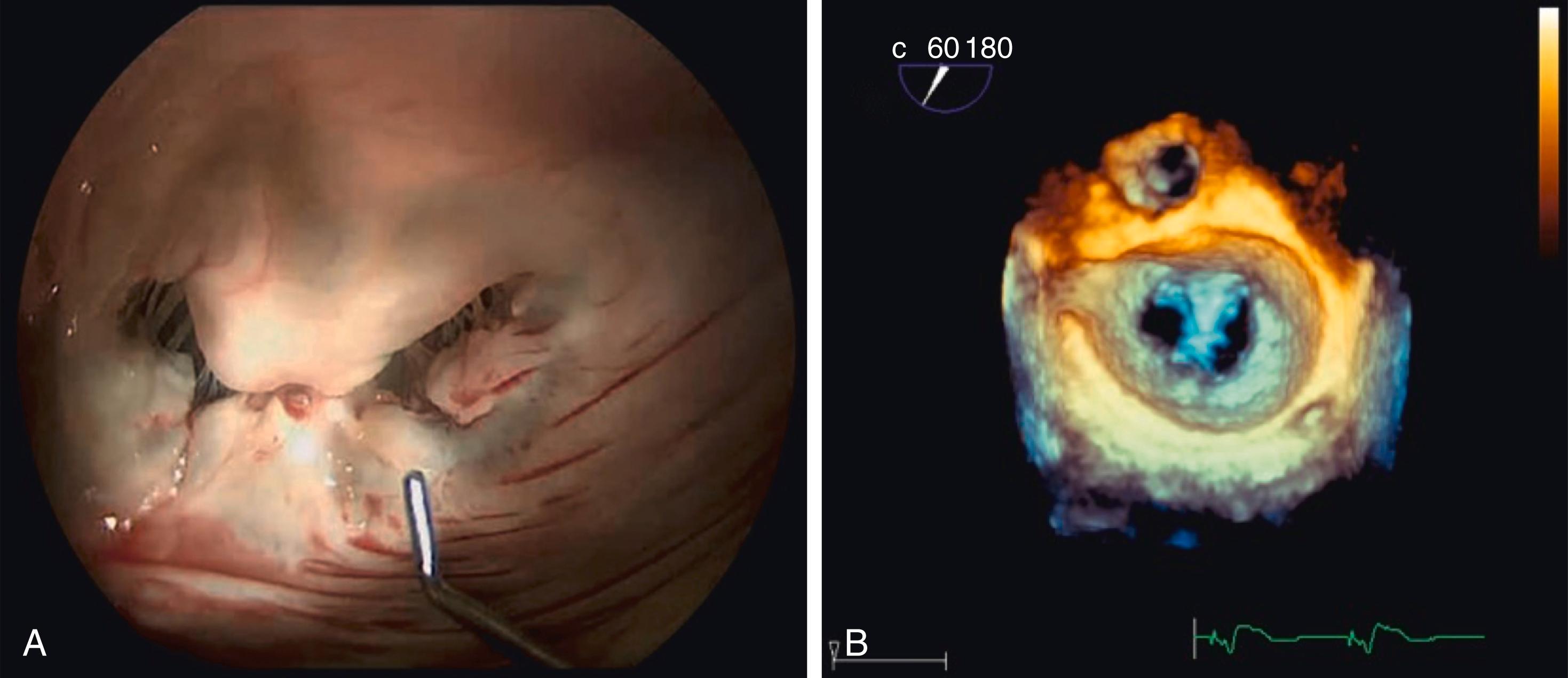 Figure 23.5, Double-orifice mitral valve. (A) Anatomic picture and (B) 3D transesophageal echocardiography image of double-orifice mitral valve after transcatheter edge-to-edge repair. 3D, Three-dimensional.