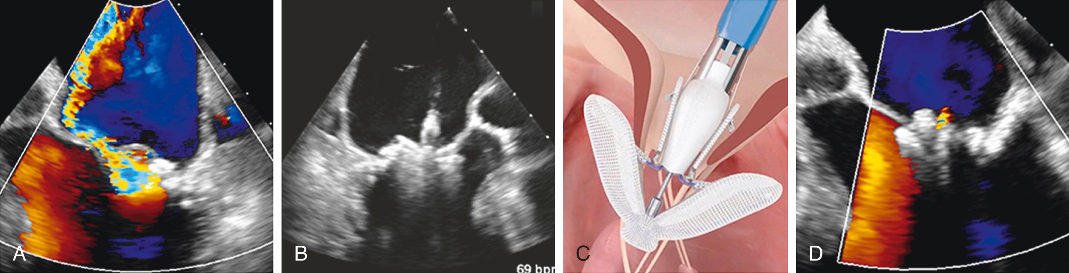 Figure 23.6, Case of leaflet approximation with PASCAL device in secondary MR. (A) Baseline color-Doppler echocardiographic assessment of MR. (B) Leaflet clasping. (C) Schematic depiction of the PASCAL system (courtesy Edwards Lifesciences). (D) Assessment of the final result with color Doppler echocardiography. MR, Mitral regurgitation.