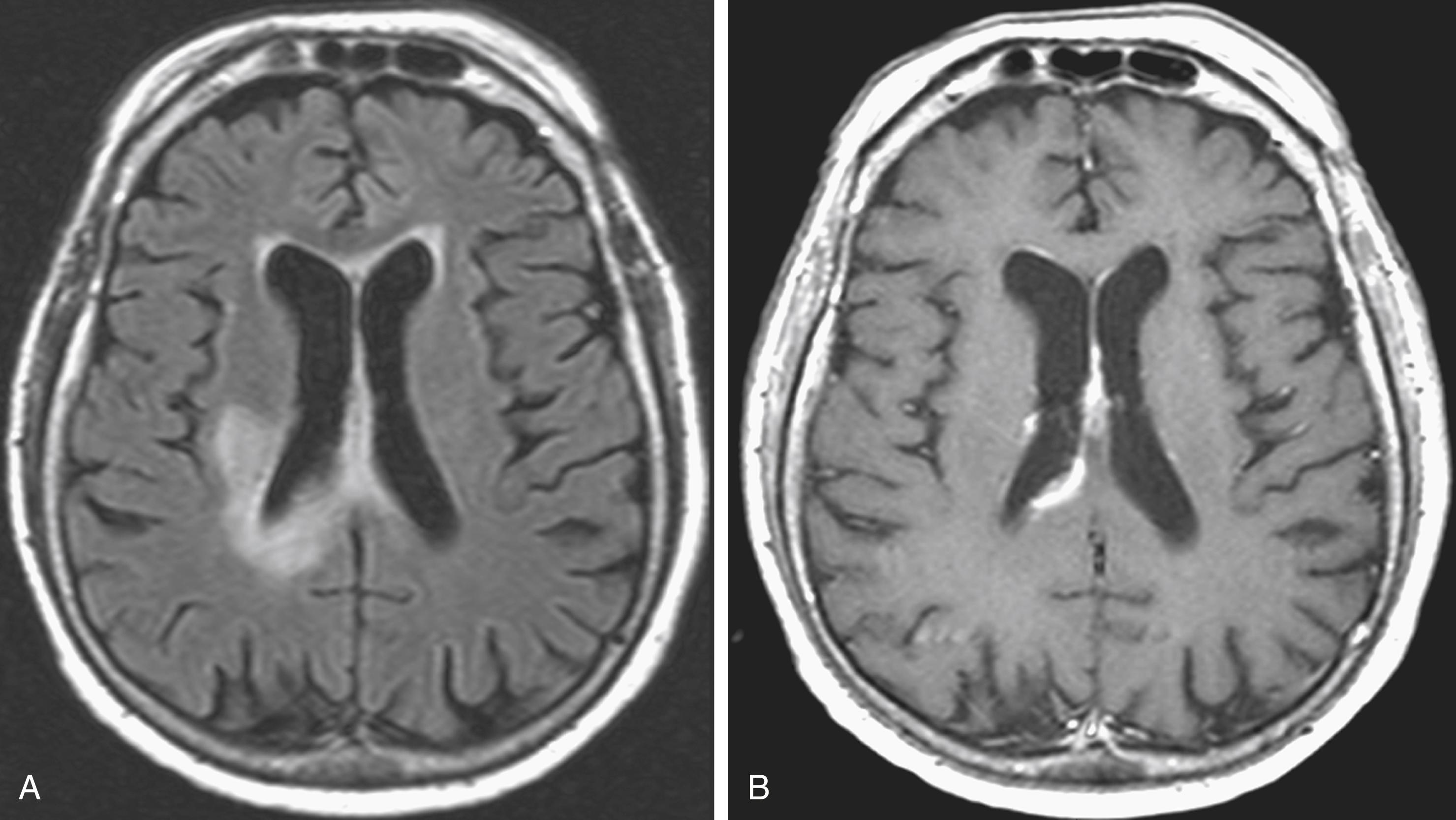 Fig. 40.22, Central Nervous System Lymphoma in an Immunocompetent Individual.