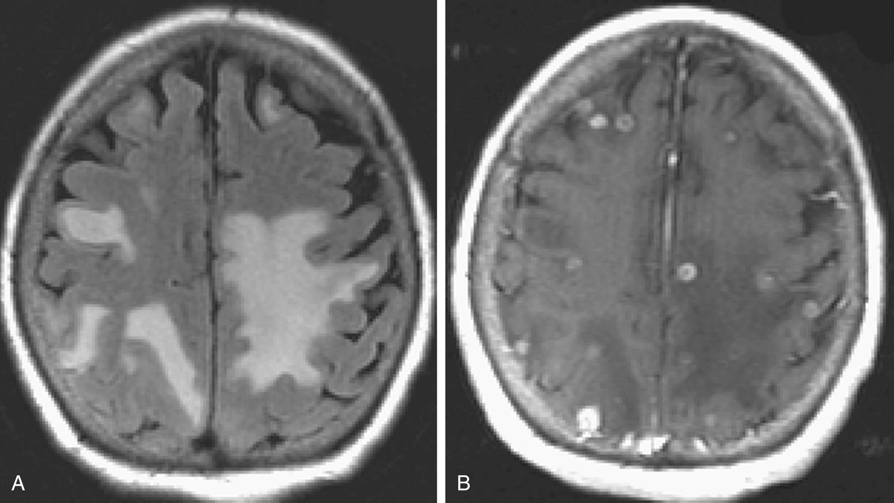 Fig. 40.29, Brain Metastases from Breast Cancer.