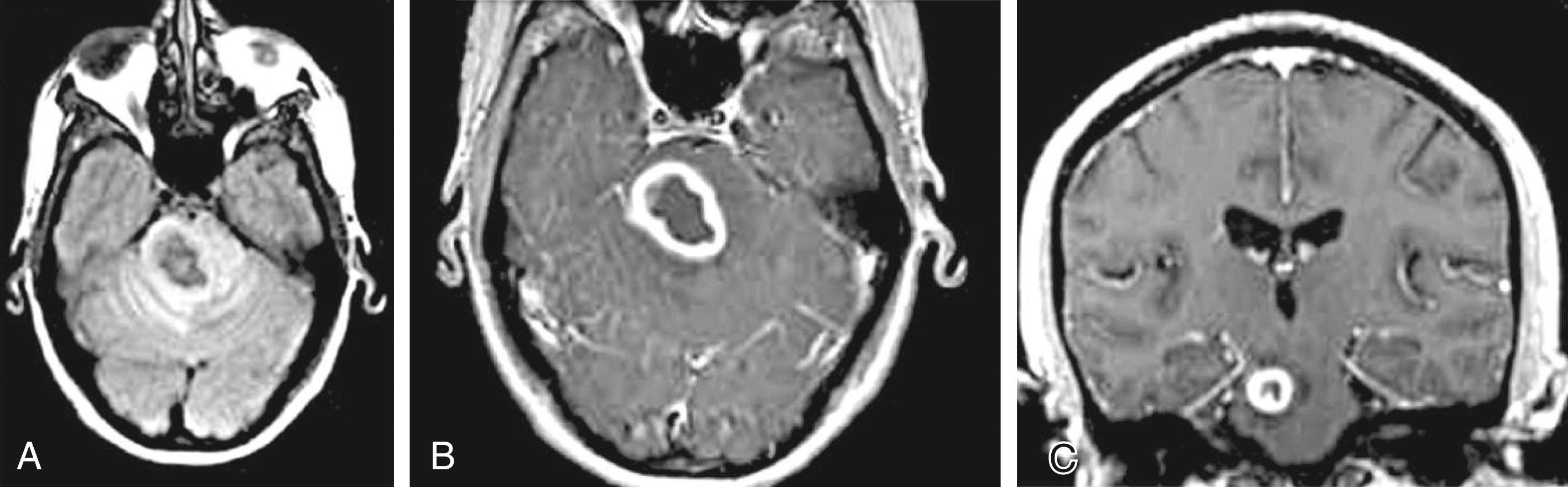 eFig. 40.53, Central Nervous System Tuberculosis.