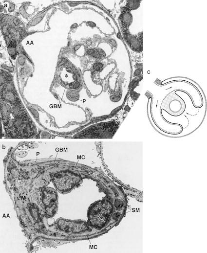 Figure 20.32, (a) Narrow association between the afferent arteriole (AA) and the intraglomerular segment of the efferent arteriole (*, EA) as seen in a section approximately 15 µm inside a glomerulus. The afferent arteriole (AA) splits into primary branches. The branching point of the AA has a narrow spatial relationship to the inraglomerular segment of the EA (asterisk), which is located in the center of the tuft. The intraglomerular segment of the EA is enclosed – together with the AA – in a common compartment bordered by the GBM. (b) Higher magnification of the intraglomerular segment in a subsequent section with several conspicuous features: the lumen is narrow; the continuous endothelium consists of four cell bodies that bulge into the lumen; the endothelium is surrounded by a mesangial envelope made up of mesangial cells (MC) and matrix; a few smooth muscle cell processes ( SM ) are interspersed. AA and EA are separated only by mesangial tissue ( M ); there is no basement membrane separating the AA and EA. P , cell body of a podocyte attached to the GBM surrounding the EA. (c) Schematic of a cross-section through the glomerular vascular pole, showing the spatial relationships of the AA and EA within the glomerular stalk corresponding to the situation in (a). Immediately after its entry into the glomerulus, the AA splits into wide capillary branches with open endothelial pores. The branching point of the AA has a narrow spatial association with the outflow segment of the EA. The outflow segment is enclosed, together with the AA, in a common compartment bordered by the GBM. The EA is completely surrounded by a layer of mesangial tissue (shown in gray), and is separated from the AA only by this layer; there is no basement membrane between AA and EA. Broken arrows represent blood flow from afferent branches through the capillary network to the outflow segment (TEMs: (a) ×~1500; (b) ×~4300).