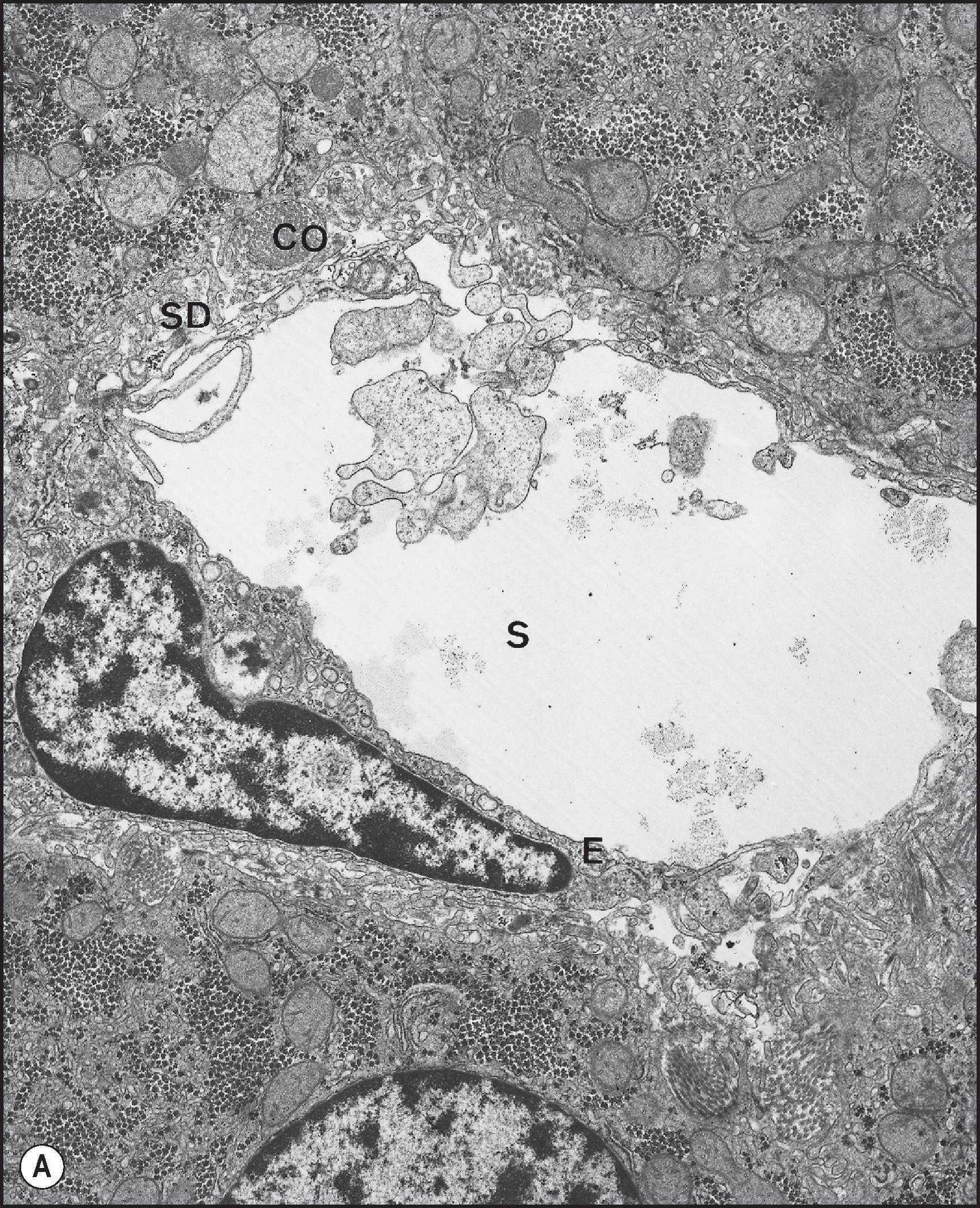 Figure 1.15, Transmission electron microscopy. (A) Sinusoid (S) with its lining endothelial cells (E) . CO , Collagen bundles; SD , space of Disse. (Human liver, ×11,500.) (B) Stellate cell (SC) in the space of Disse. Note cell processes, a single small lipid droplet and rough endoplasmic reticulum. (Human liver, ×11,500.) (C) Kupffer cell with numerous cytoplasmic lysosomes (L). Note irregular microvillous projections (MV) ; sinusoidal lumen (SL). Small rims of endothelial lining cells are observed at both sides of the Kupffer cell. (Human liver, ×9200.) (D) Liver-associated lymphocyte within a sinusoid. Note dense granules in the cytoplasm (arrows). (Human liver, ×18,400.)