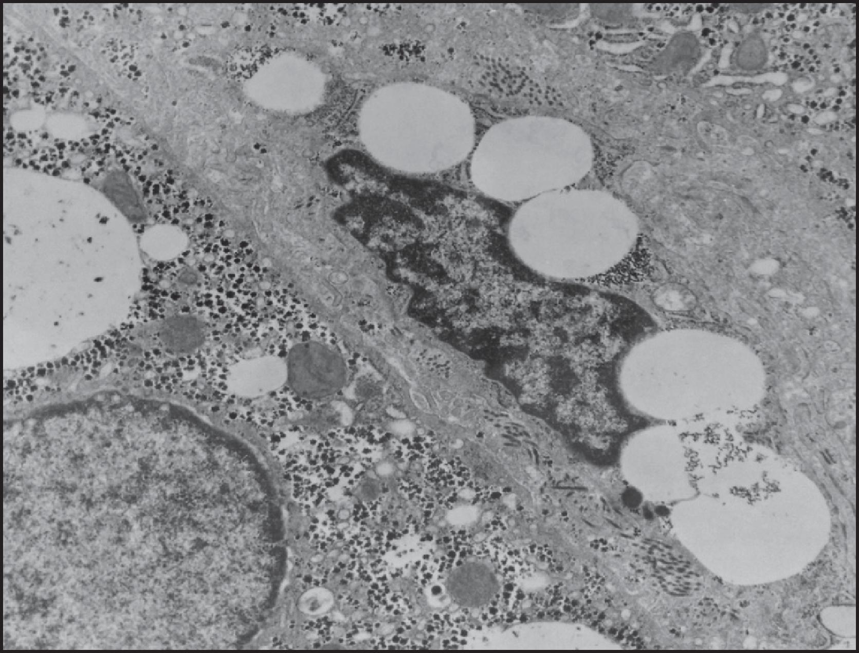 Figure 1.18, Transmission electron microscopy. A quiescent stellate cell contains lipid droplets and is adjacent to a parenchymal hepatocyte (lower left) .