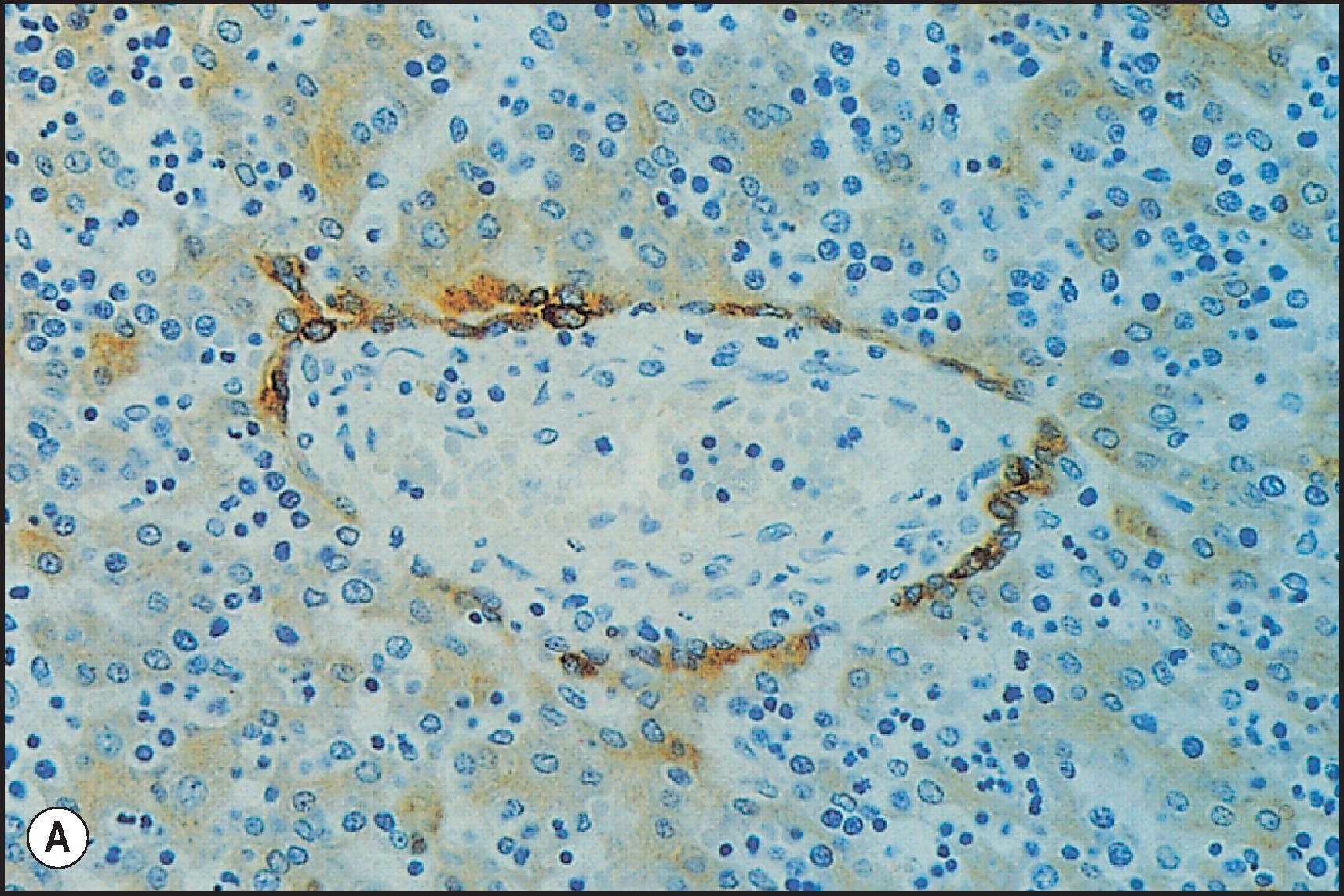 Figure 1.3, Development of the ductal plate and of intrahepatic bile ducts. (A) Expression of K19 in primitive hepatocytes at the interface with the mesenchyme of the primitive portal tracts; human fetus of 12 weeks’ gestation. (B) Later stage showing a discontinuous double-layered plate of K19 positive epithelial cells at the mesenchymal interface; note the formation of tubular structures (upper right) within this plate. Human fetus of 14 weeks’ gestation (immunoperoxidase staining); antibody (5D3) to low-molecular-weight keratins.