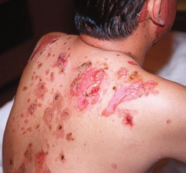 Figure 2.2, Pemphigus vulgaris – an autoimmune blistering disease wherein antibodies directed against desmosomes result in keratinocyte separation in stratum spinosum.