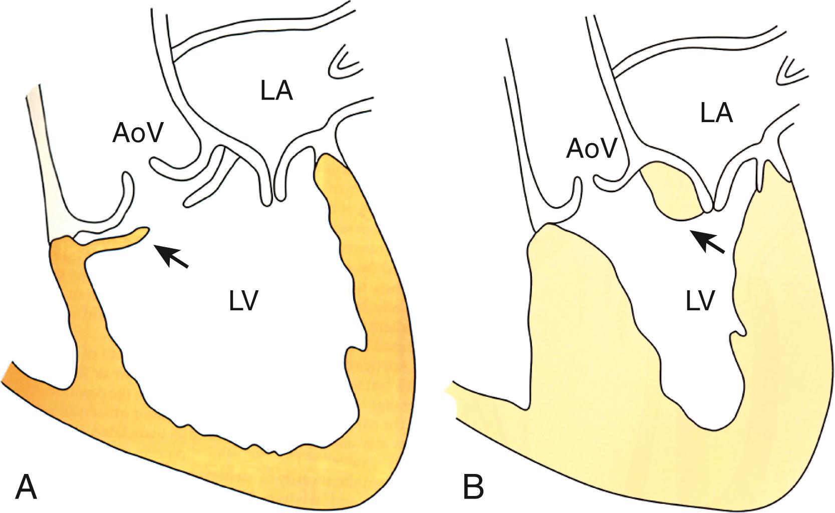 Figure 85.1, A, Subaortic discrete membrane. B, Tunnel-like subaortic stenosis showing subaortic stenosis (arrow) . AoV , Aortic valve; LA , left atrium; LV , left ventricle.