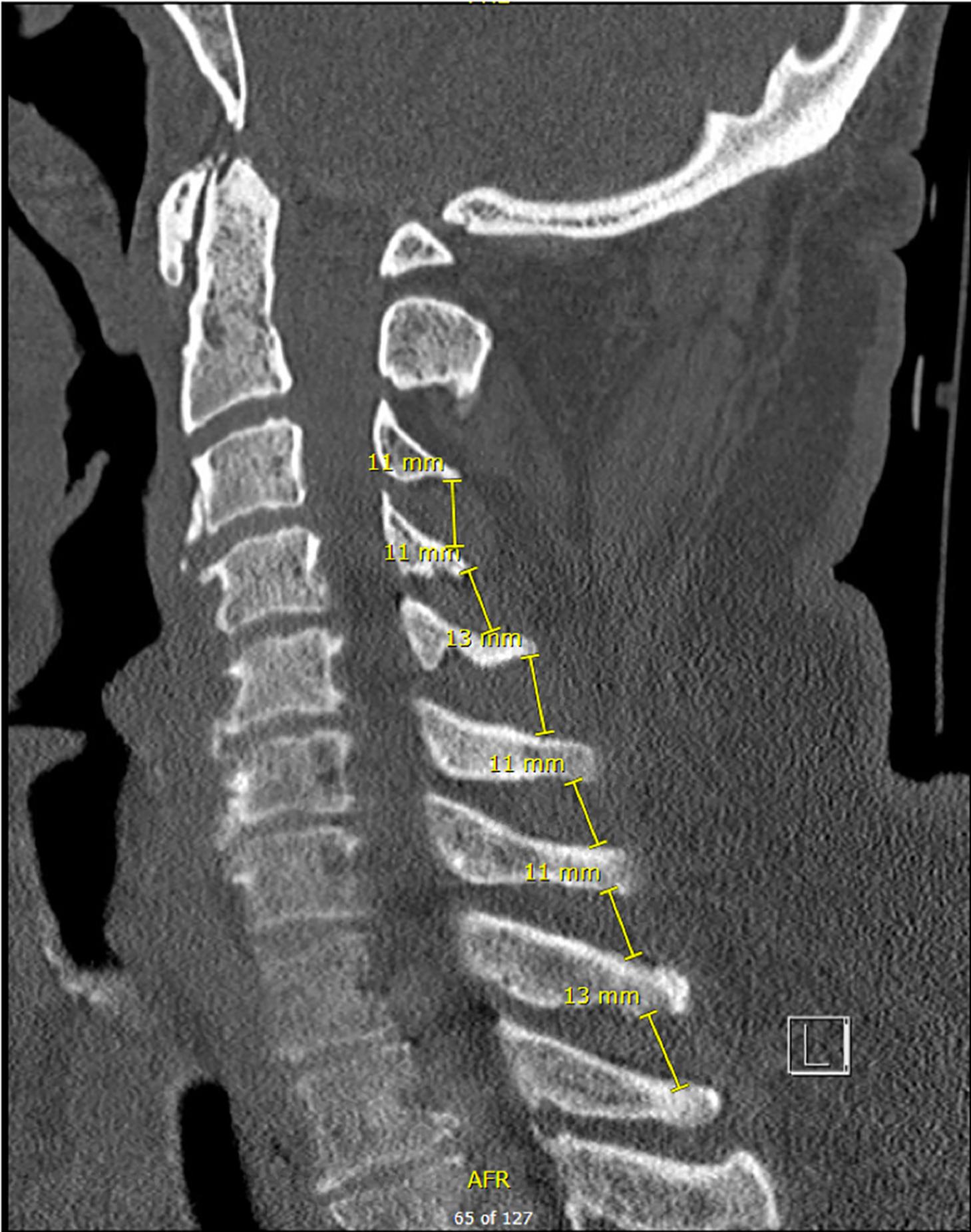 Fig. 3, ISD measurements on sagittal CT imaging.