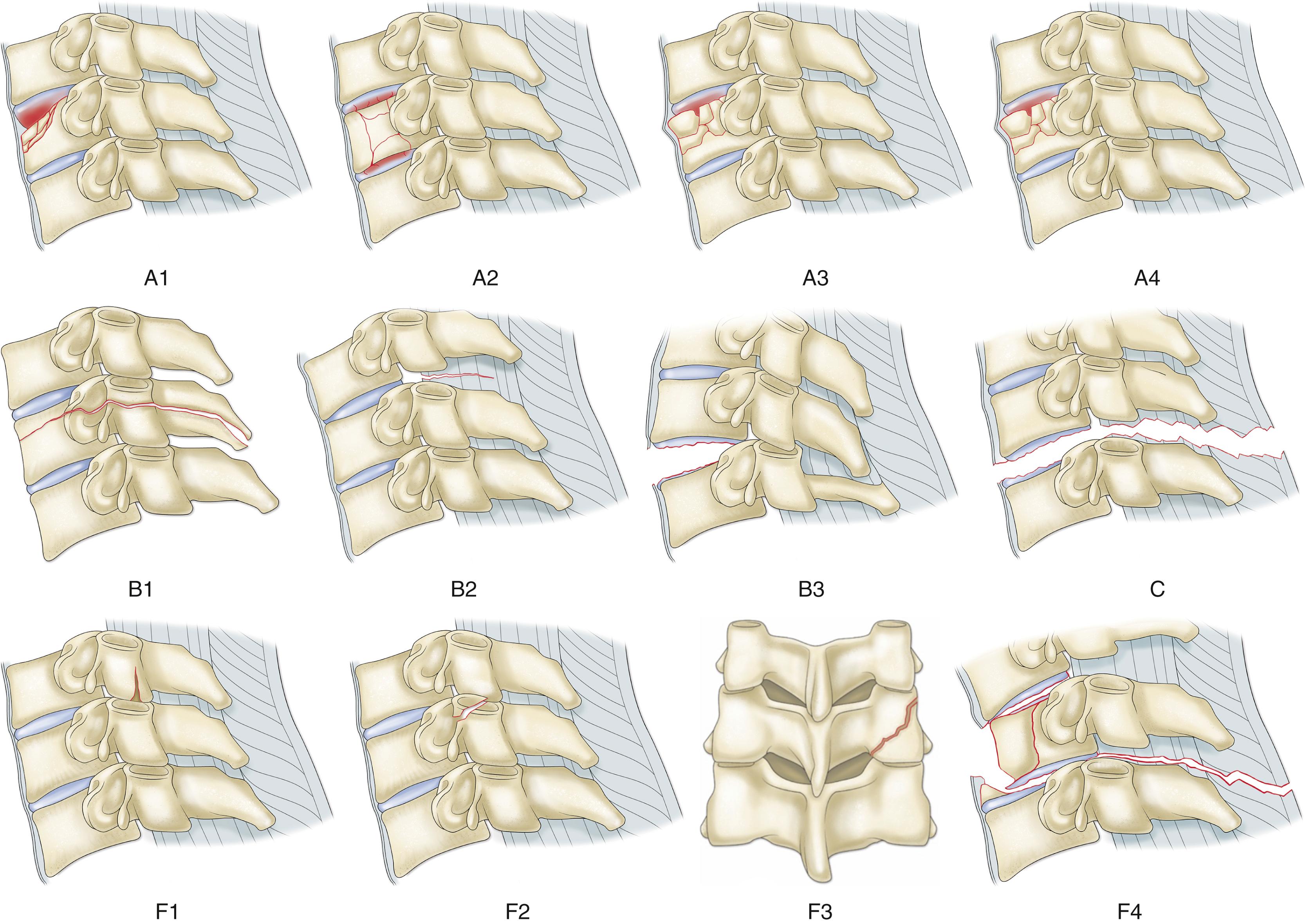 Fig. 36.3, AOSpine classification of cervical spine fractures.