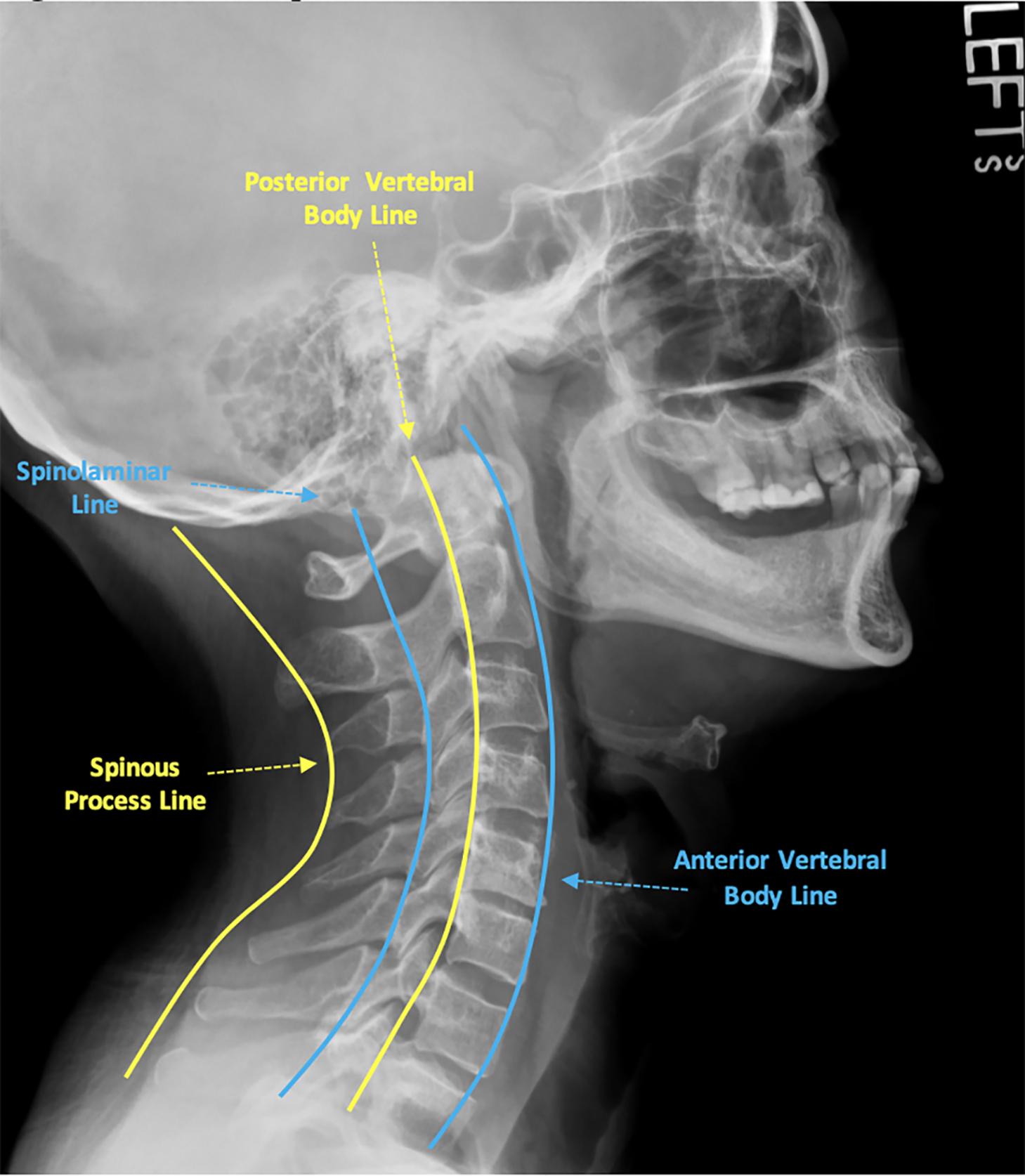 Fig. 1, Cervical spine contour lines. Lateral radiograph of the cervical spine demonstrating contour lines.