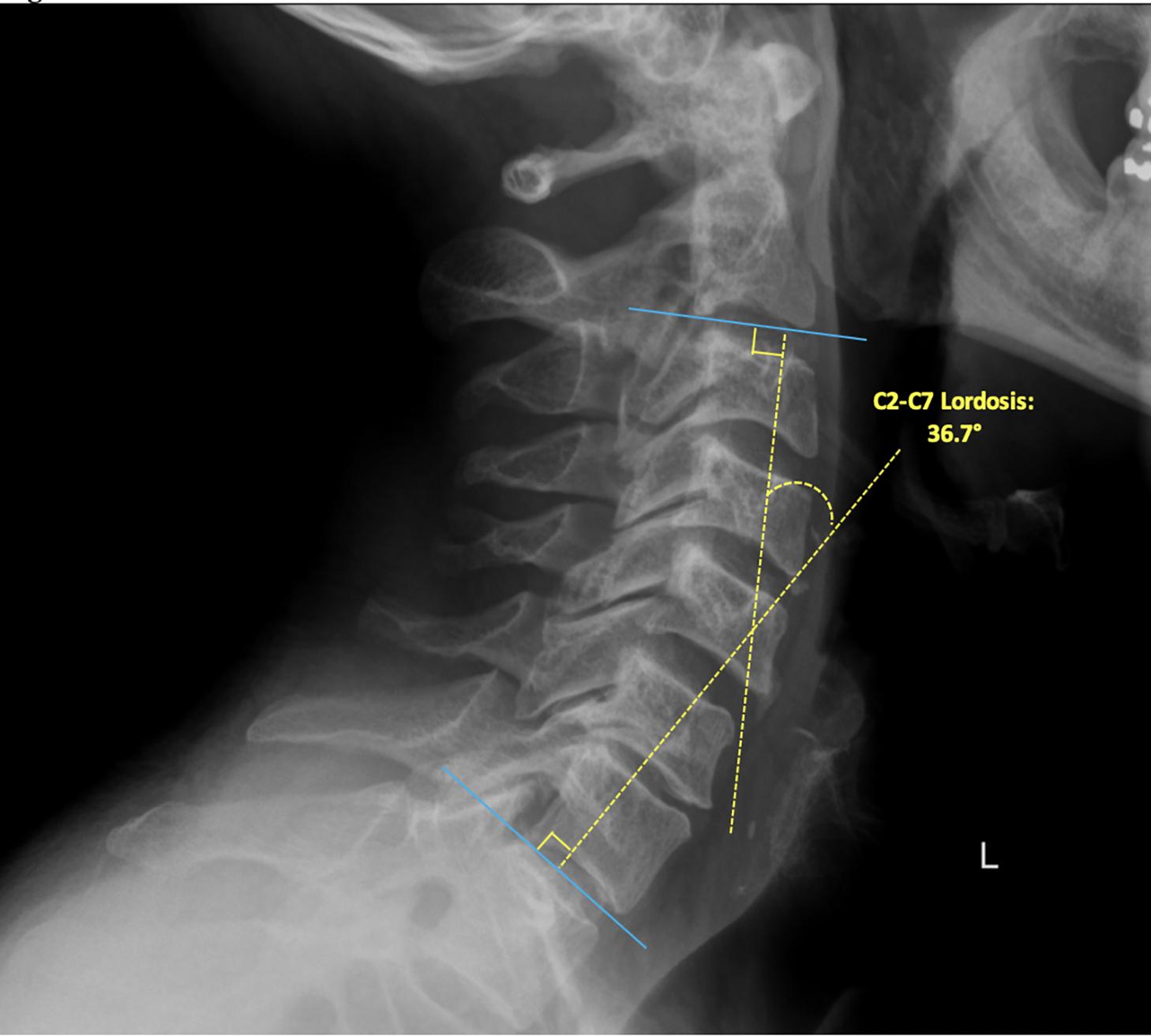 Fig. 2, C2–C7 cervical lordosis assessments. Cobb angle measurement of the sagittal curvature from C2 to C7.