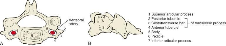 Fig. 32.1, Osseous anatomy of the subaxial cervical spine. (A) Typical vertebral body viewed from above. (B) Viewed from left side. Cervical pedicles (6) are very short and extend at a medial angle from the superior articular process (1) . The lateral mass (consisting of the superior [1] and inferior [7] articular processes] is rhomboid in shape when viewed from the lateral view. The superior surface of the vertebral body (5) is raised at the posterolateral corners to form the uncovertebral joints.