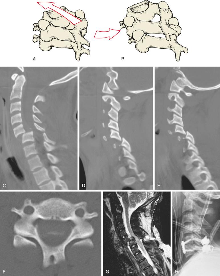 Fig. 32.11, (A) Bilateral facet dislocation mechanism. With sufficient forward flexion with distraction (A), both facets can dislocate (B). With lesser distraction and more forward translation, the facets can fracture. (C and D) A 29-year-old female with bilateral C5–C6 facet dislocation after a motor vehicle accident with incomplete spinal cord injury (AOSpine type C; F4; F4, N3). (E) Axial computed tomography (CT) scan shows the inferior facet of the superior vertebra completely dislocated anteriorly to the superior facets of the caudal vertebra. Magnetic resonance imaging (MRI) shows spinal cord edema (F). Circumferential stabilization of bilateral facet dislocations offers the most rigid stability to prevent deforming forces due to discoligamentous disruption from causing late kyphotic collapse and resultant deformity (G and H).