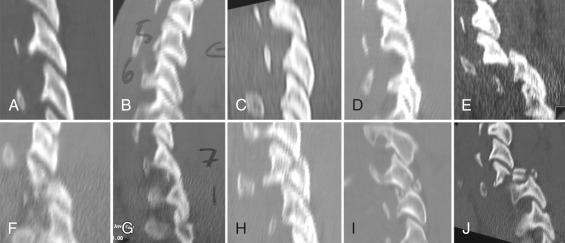Fig. 32.12, Different facet injuries that may result from various combinations of flexion, compression, and rotation. Different configurations of facet injuries can occur, depending on the extent and timing of the forces acting on the spine at the time of injury. The top row (A–E) demonstrates a spectrum of purely ligamentous injuries, starting from the normally aligned facet (A). The facet capsule may be disrupted with subtle widening (B), and greater soft tissue disruption leads to facet subluxation (C), perching (D), and frank dislocation (E). The bottom row (F–J) demonstrates various fracture patterns. Most commonly, the superior facet is fractured and pushed forward into the foramen (F). Superior facet fracturing can be associated with facet subluxation or dislocation as well (G). Less commonly, the inferior facet is fractured—a pattern that may be associated with extension injuries and that often compromises the ability to place screws into this segment (H). Both the inferior and superior facets may be fractured (I). Finally, significant comminution of the facet (J) may preclude stable screw fixation at this level.