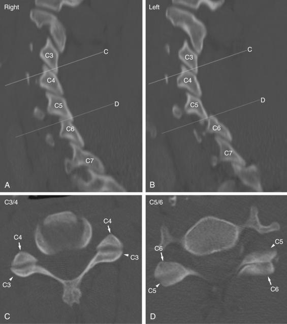 Fig. 32.2, Shingling of the facets in the subaxial cervical spine. The rhomboid-shaped facets overlap in a “shingling” pattern in the subaxial cervical spine. This is well visualized in the sagittal computed tomography (CT) reconstructions of the right (A) and left (B) facets. Note the left-sided C5–C6 facet fracture dislocation (B). On the axial cuts of the normal C3–C4 level (C), note the shingling pattern of the facets, the superior facet of C4 is anterior to the inferior facet of C3. (D) At the level of the injury, note that the right-sided facets have maintained their alignment, with the superior facet of C6 being anterior to the inferior facet of C5. However, on the left, the C5 inferior facet is anterior to the C6 superior facet.