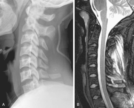 Fig. 32.5, Typical C6 spinous process avulsion fracture (AOSpine type A0) seen on lateral radiograph (A) and magnetic resonance imaging (MRI). (B). Classically called a “clay shoveler's fracture,” it most commonly occurs at C6, C7, and T1.