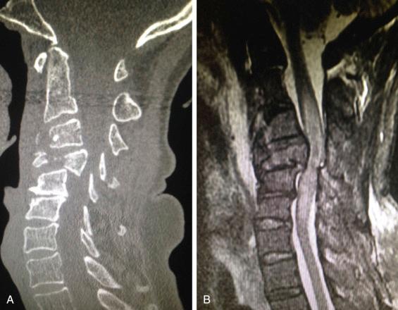 Fig. 32.6, (A) Computed tomography (CT) scan demonstrating a C3 complete burst fracture (AOSpine type A4) with retropulsion of the vertebral body into the spinal canal. (B) Magnetic resonance imaging (MRI) shows thecal sac compression with spinal cord edema resulting in complete spinal cord injury (AOSpine neurologic status modifier N4).