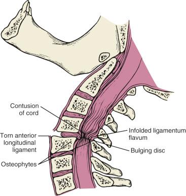 Fig. 32.7, The anterior distraction injury can result in a “pincer-like” compression injury to the spinal cord. The spinal cord is compressed by both the disc and/or disc–osteophyte complex anteriorly as well as the infolding of the ligamentum flavum posteriorly.