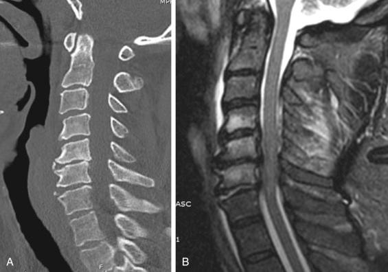 Fig. 32.8, (A) A 59-year-old male was intoxicated and fell down an embankment; he presented with central cord syndrome with bilateral upper extremity pain, weakness, and numbness. A computed tomography (CT) scan revealed slight distraction of the C6–C7 disc space with an avulsed C6 anteroinferior endplate osteophyte fracture (“extension teardrop”). (B) Magnetic resonance imaging (MRI) showed disruption of the C6–C7 disc space with multilevel stenosis and associated cord edema (AOSpine C6-7:B3; neurologic modifier N3).