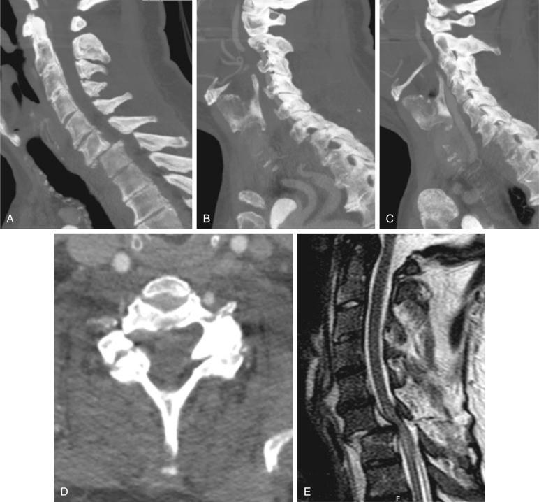 Fig. 32.9, (A) A 56-year-old female was in a motor vehicle accident and suffered a C6–C7 fracture dislocation with translation of C6 on C7 (AOSpine type C), a dislocated facet on the right side (F4) (B) and a fractured and subluxed facet on the left side (F4) (C), and a complete spinal cord injury (neurologic status modifier N4) with cord edema seen on magnetic resonance imaging (MRI) (D). Axial computed tomography (CT) scan shows the inferior facet of the superior vertebra completely translated anteriorly to the superior facets of the caudal vertebra (E).