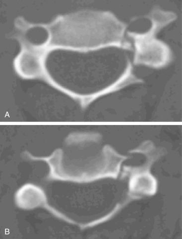 Fig. 32.10, Floating lateral mass (type F3). (A) Axial computed tomography (CT) shows fractured lamina. (B) Another CT slice shows the fractured pedicle and the fracture extending into the foramen transversarium. The free-floating lateral mass has the potential to destabilize both rostral and caudal levels.