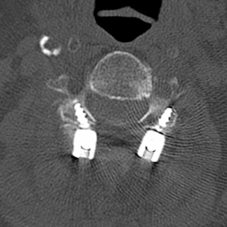 Lateral Mass Screws