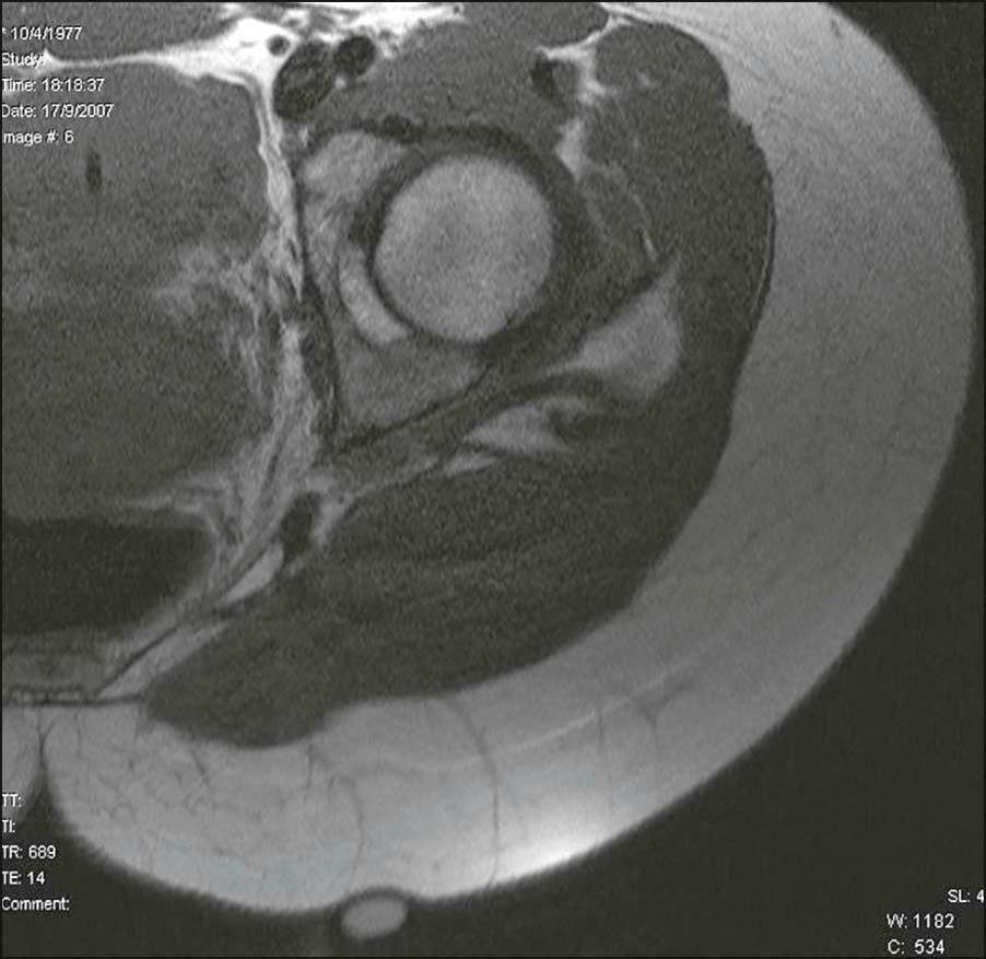 Figure 16.1, Magnetic resonance imaging of a depressed cellulite lesion with subjacent fibrous septa
