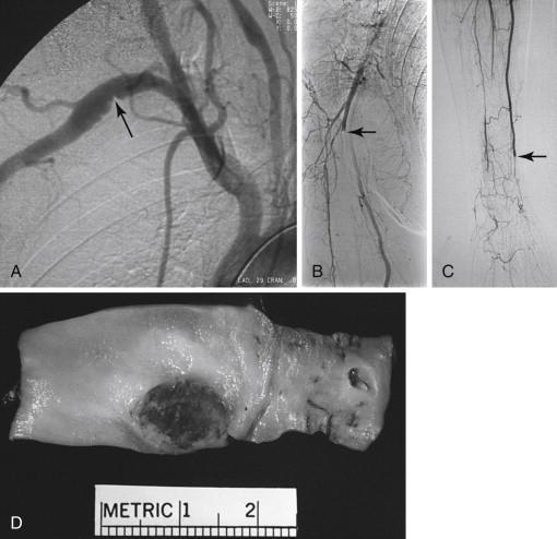 FIGURE 1, A, B, and C, Arteriogram of a patient with a distal subclavian aneurysm in whom there is distal embolization of thrombus in the brachial, radial, and ulnar arteries . D, Pathologic examination of the artery shows ulceration and thrombus within the aneurysm. The indentation from the cervical rib can be seen.