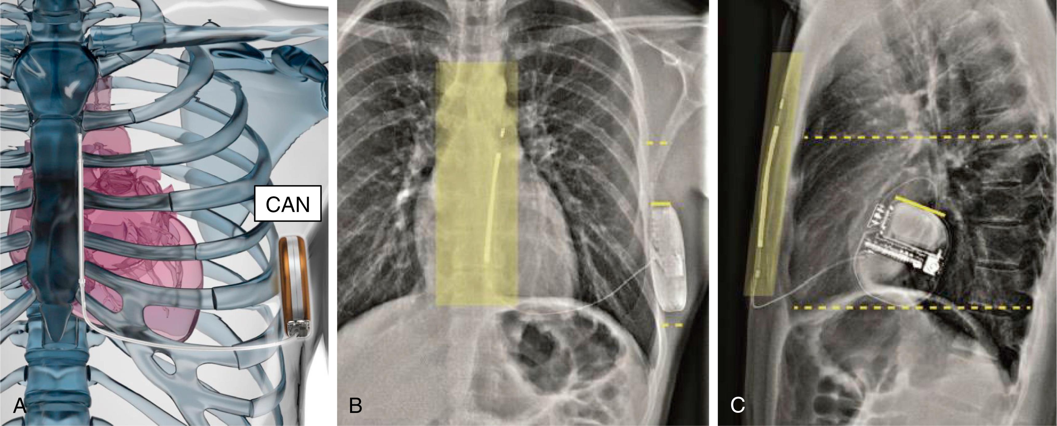 Fig. 123.2, General setup of the subcutaneous implantable cardioverter-defibrillator (S-ICD) system and the Praetorian score.