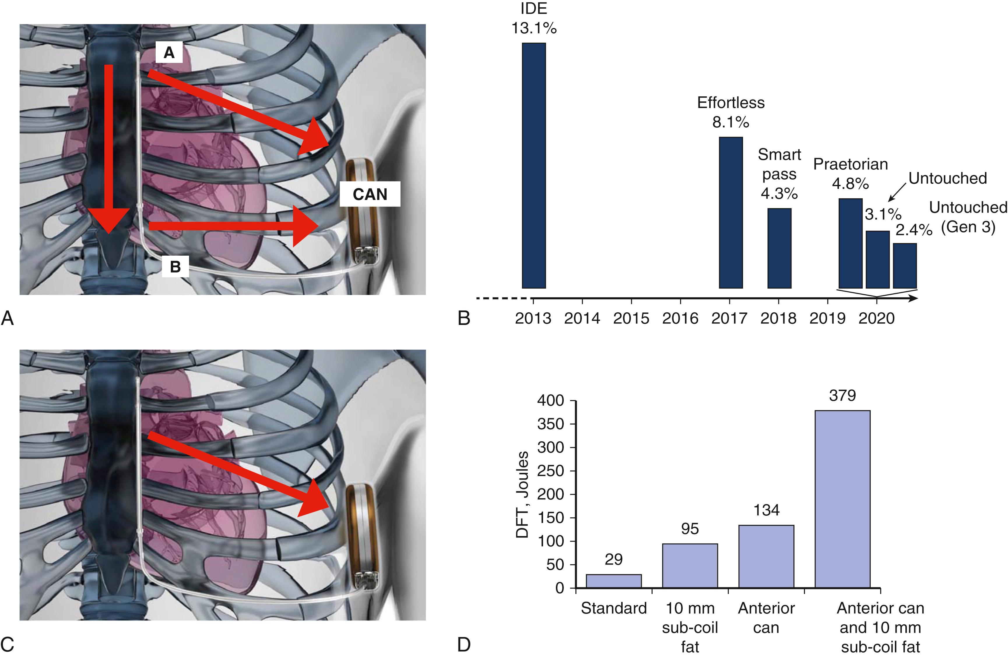 Fig. 123.3, Key functions of the subcutaneous implantable cardioverter-defibrillator (S-ICD) of sensing and defibrillation.