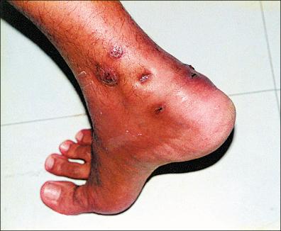 Figure 18-1, Lesion on right heel showing increased volume and multiple fistulae ( Nocardia brasiliensis ).