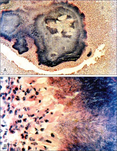 Figure 18-3, ( A ) Hematoxylin and eosin (H&E)-stained histopathology of skin with Actinomadura madurae grains (10×); ( B ) H&E-stained histopathology of skin with A. madurae grains (1000×).