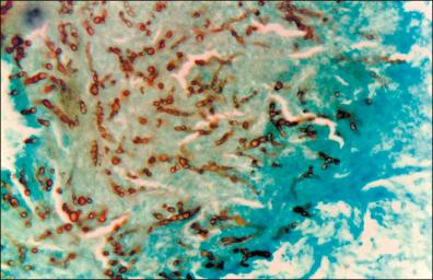 Figure 18-4, Grocott-stained histopathology of skin with M. mycetomatis grains (40×).