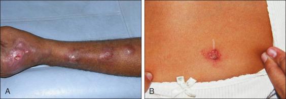 Figure 18-5, Sporotrichosis: ( A ) lymphocutaneous and ( B ) cutaneous fixed lesions.