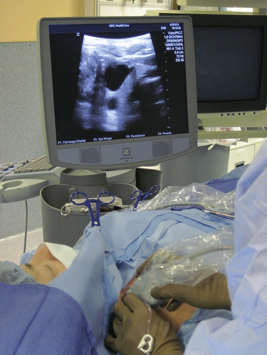 Fig. 85.2, Ultrasound probe in operator’s right hand guides a 21-gauge needle while accessing right internal jugular vein. Operator should keep needle tip visualized throughout access process.