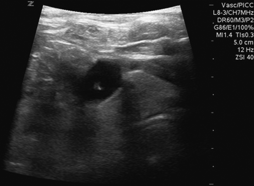 Fig. 85.3, Tip of needle within right internal jugular vein. One should always confirm position of needle tip with ultrasound before proceeding.