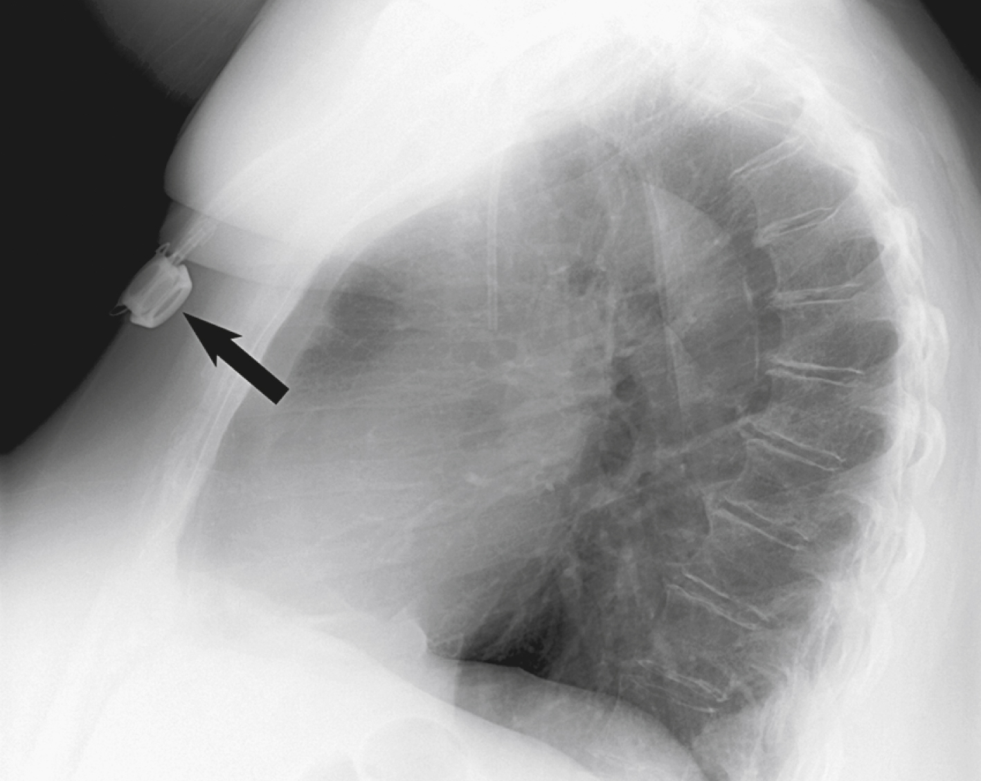 Fig. 85.5, Lateral chest radiograph showing that 2 weeks after insertion, this port had flipped 180 degrees within pocket. Diaphragm (arrow) is identified along deep margin of pocket. This port was manually flipped back into appropriate position (without opening pocket) and successfully accessed thereafter.