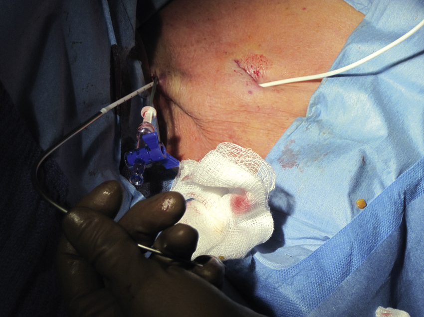 Fig. 85.6, Tunneler is then brought through neck dermatotomy site. Port will be placed in port pocket and catheter will be cut to length.