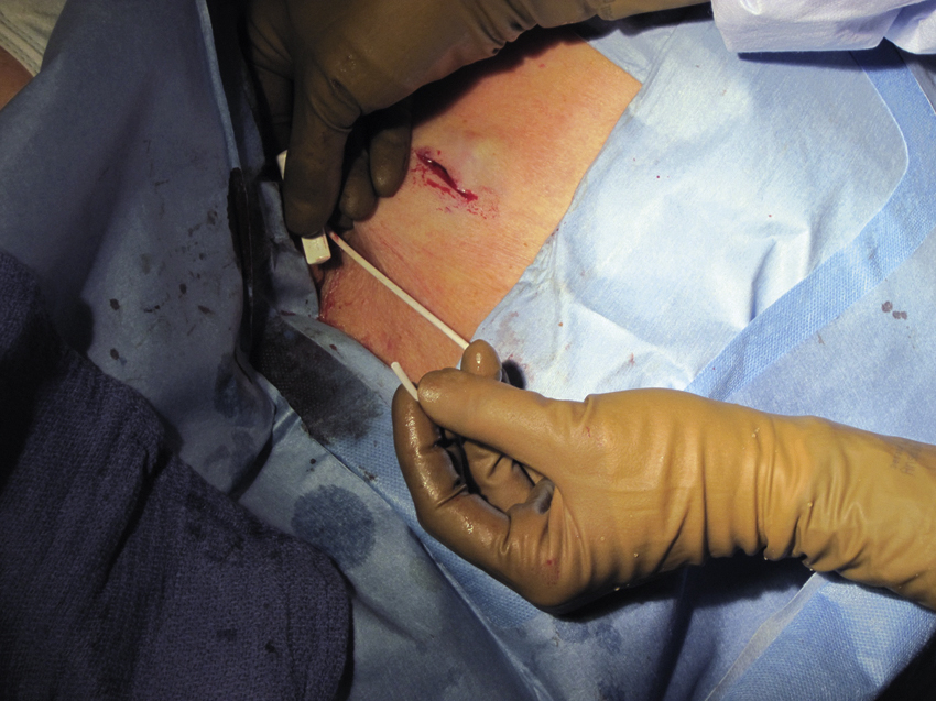 Fig. 85.7, Operator covers peel-away sheath with right thumb while quickly introducing catheter with left hand.