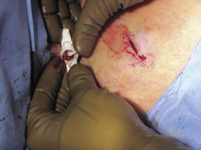 Fig. 85.8, Catheter advanced into peel-away sheath while sheath is removed.