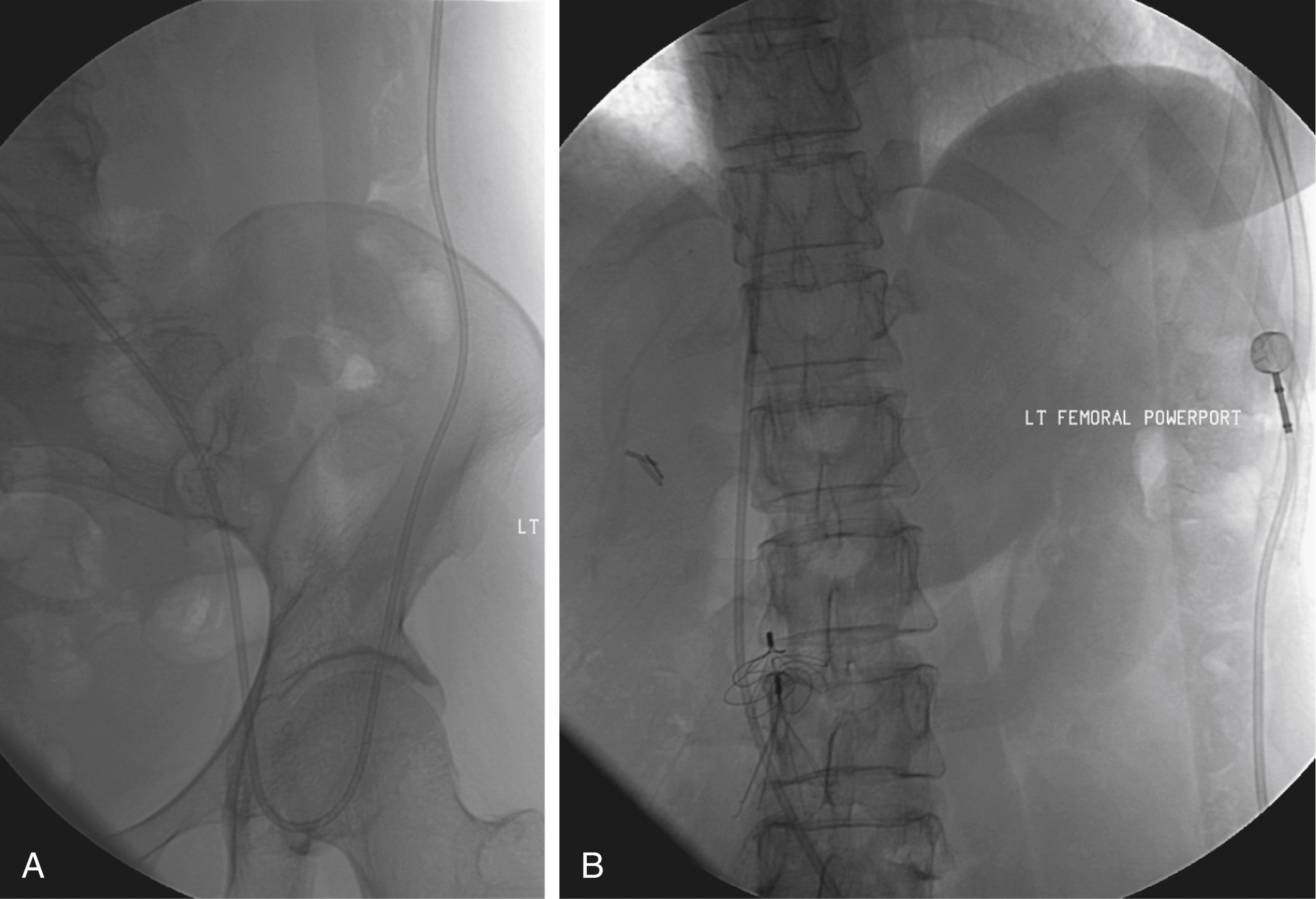 Fig. 85.9, (A) A femoral approach is rarely considered because of increased risk of infection associated with this site; however, if it is used, maximal sterile barrier technique should be rigorously employed. (B) Port should be positioned over ribs to allow a firm backing for access.