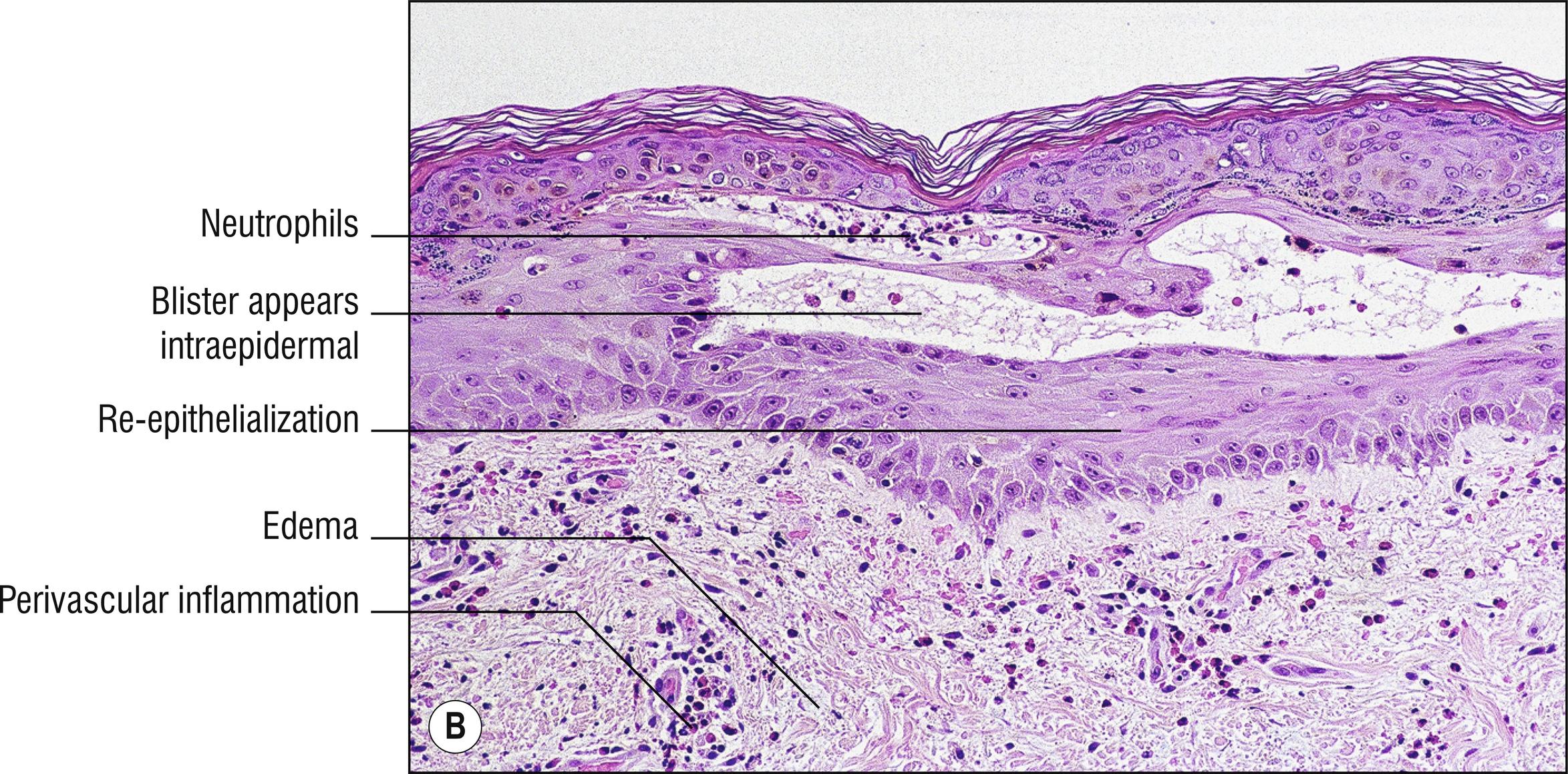 Fig. 6.1, B Bullous pemphigoid (re-epithelialization).