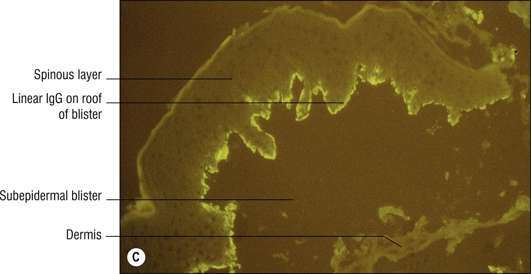 Fig. 6.1, C Bullous pemphigoid (IgG immunofluorescence), staining on roof of blister, in contrast to EBA.