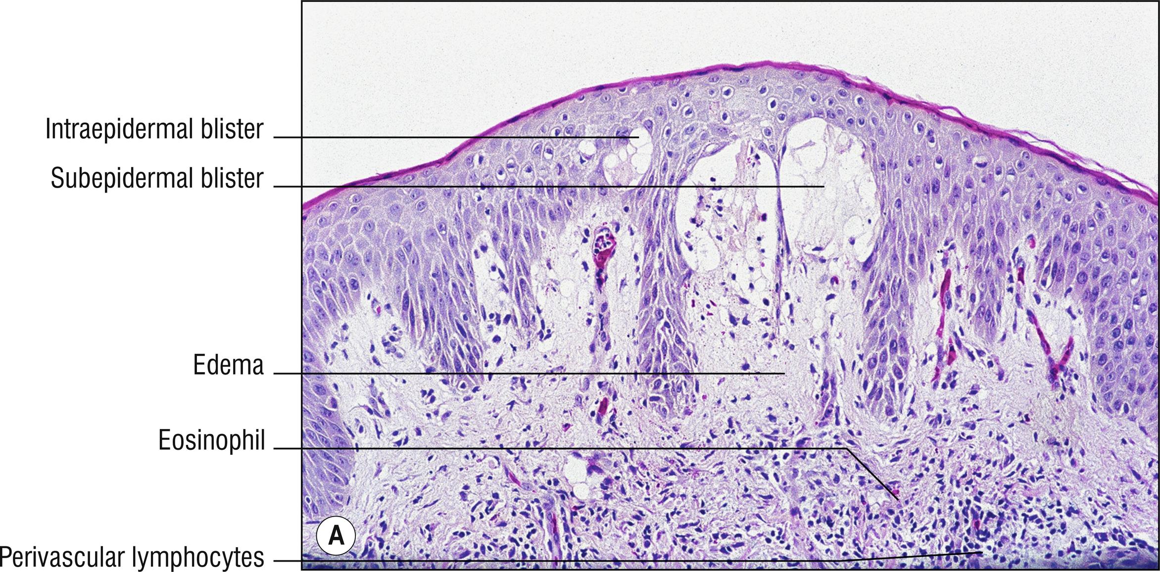 Fig. 6.3, A Pemphigoid gestationis.