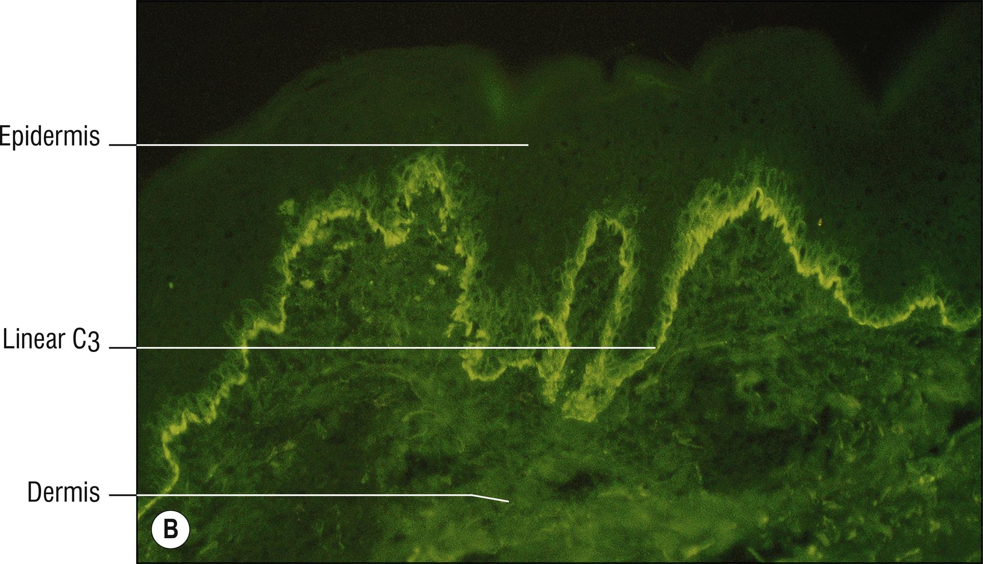 Fig. 6.3, B Pemphigoid gestationis (C3 immunofluorescence).